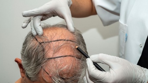 Turkey Hair Transplant Cost