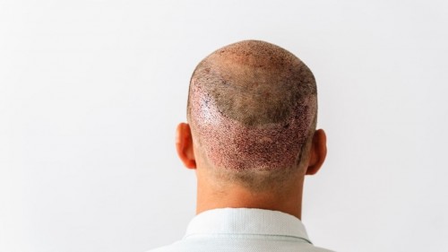 Hair Transplant Turkey